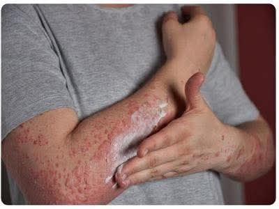 أول حالة وفاة مسجلة بسبب &Quot;حساسية اللحوم&Quot; الناتجة عن لدغات القراد: قصة تحذيرية من نيوجيرسي 2 Fb img 17632645007786773867437764266982